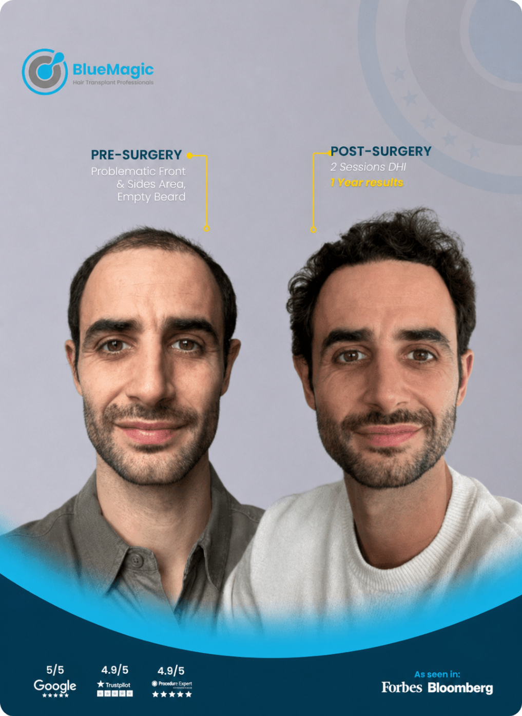 Before and after hair transplant result showing fuller hairline and improved beard density after 1 year.