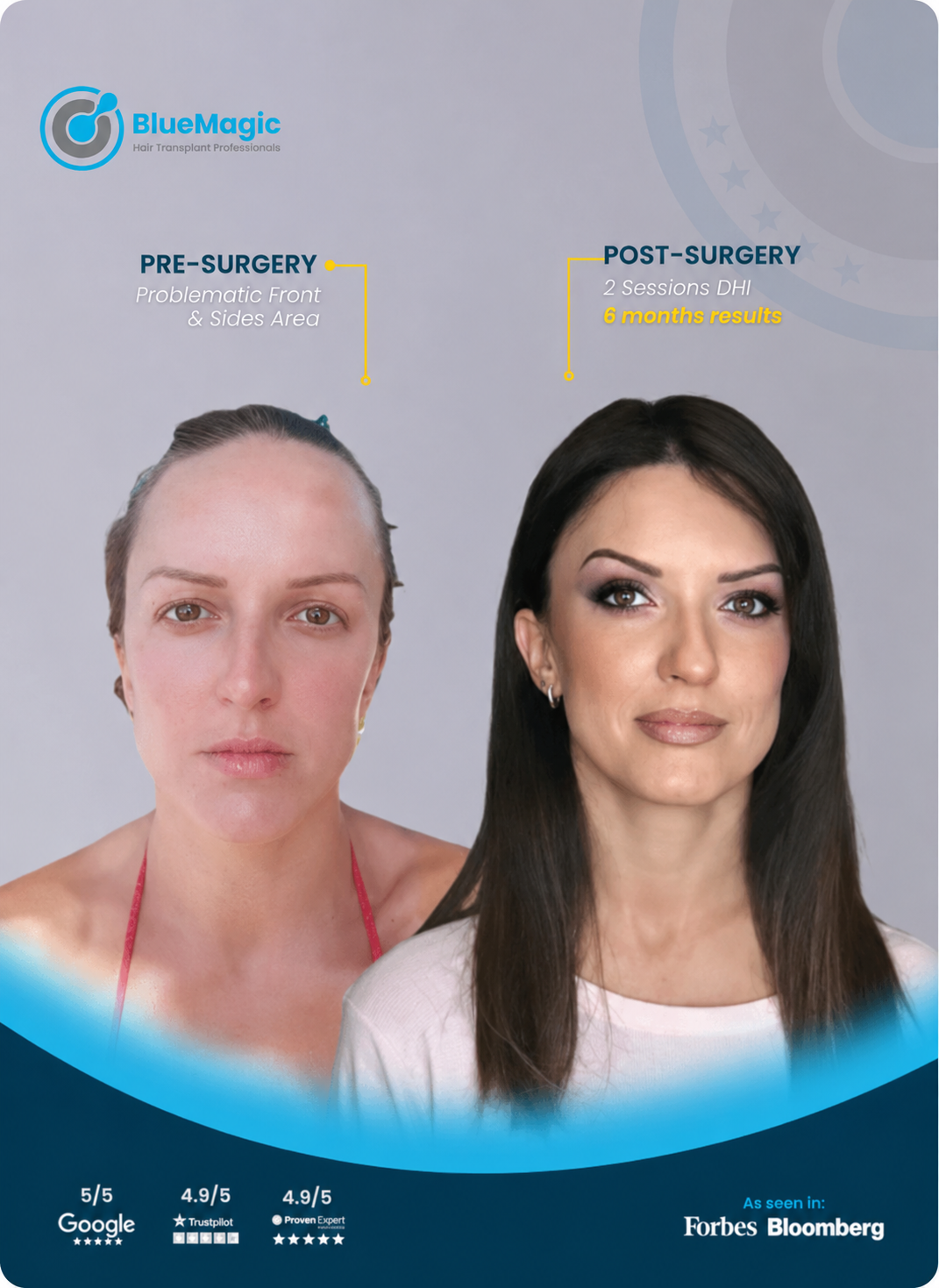 Before and after female hair restoration result showing stronger frontal density after 6 months.
