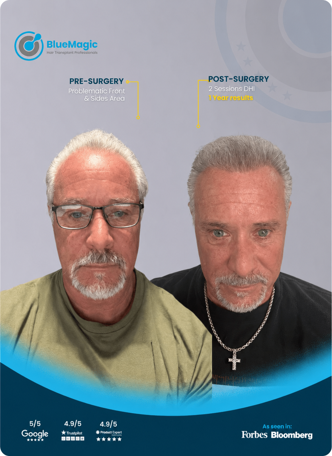 Before and after male hair transplant result showing a restored hairline after 1 year.