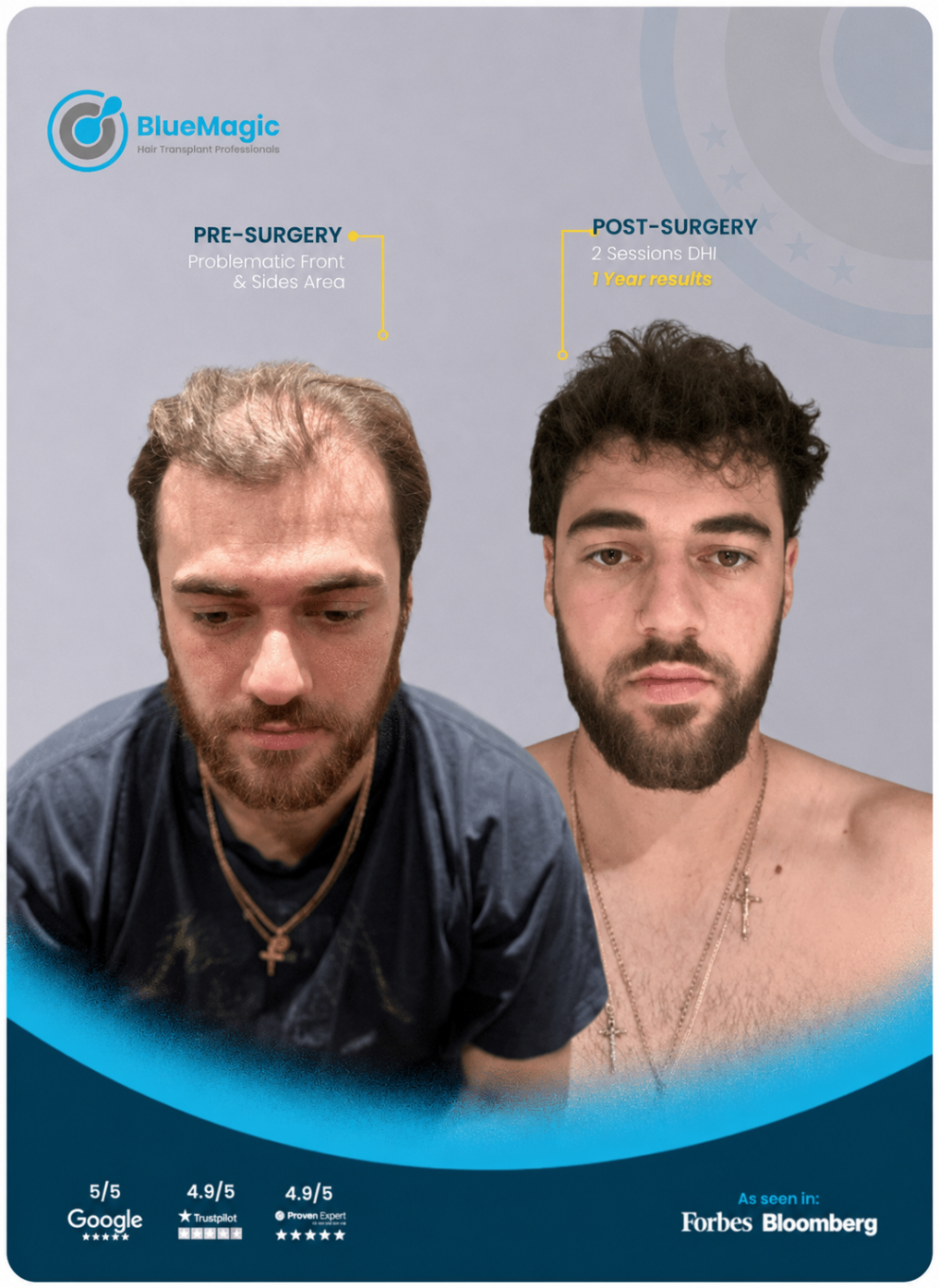 Before and after hair transplant result showing stronger frontal coverage after 1 year.