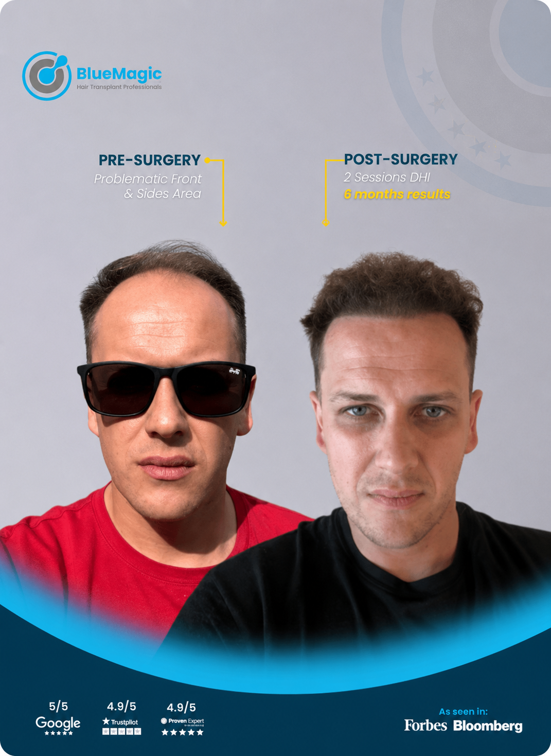 Before and after hair transplant result showing early hairline improvement after 6 months.