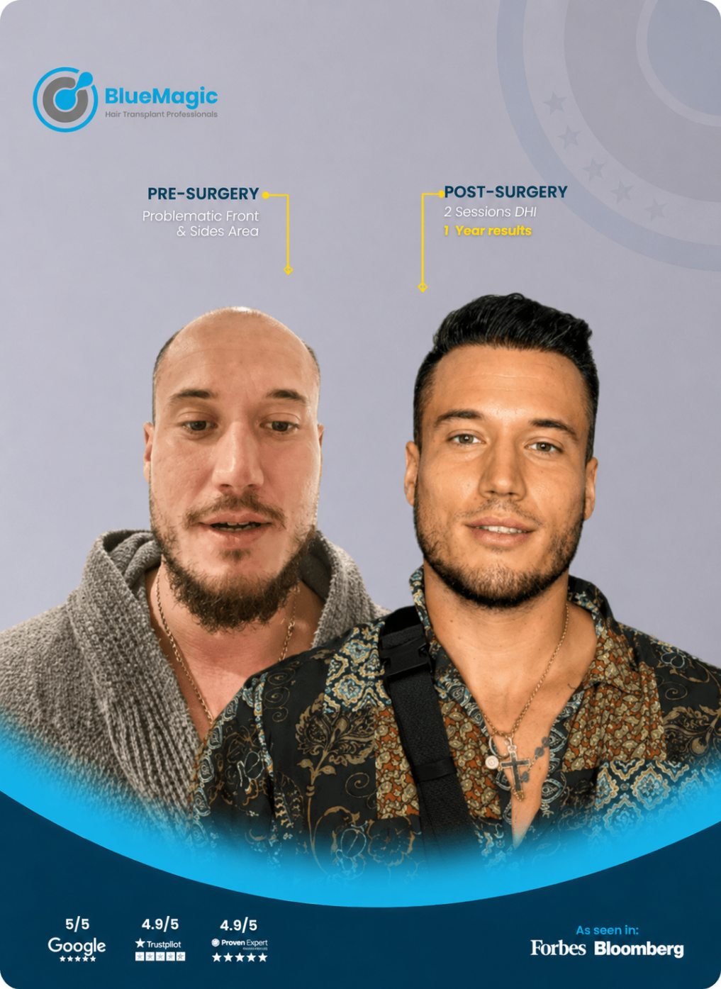 Before and after hair transplant result showing fuller top density after 1 year.