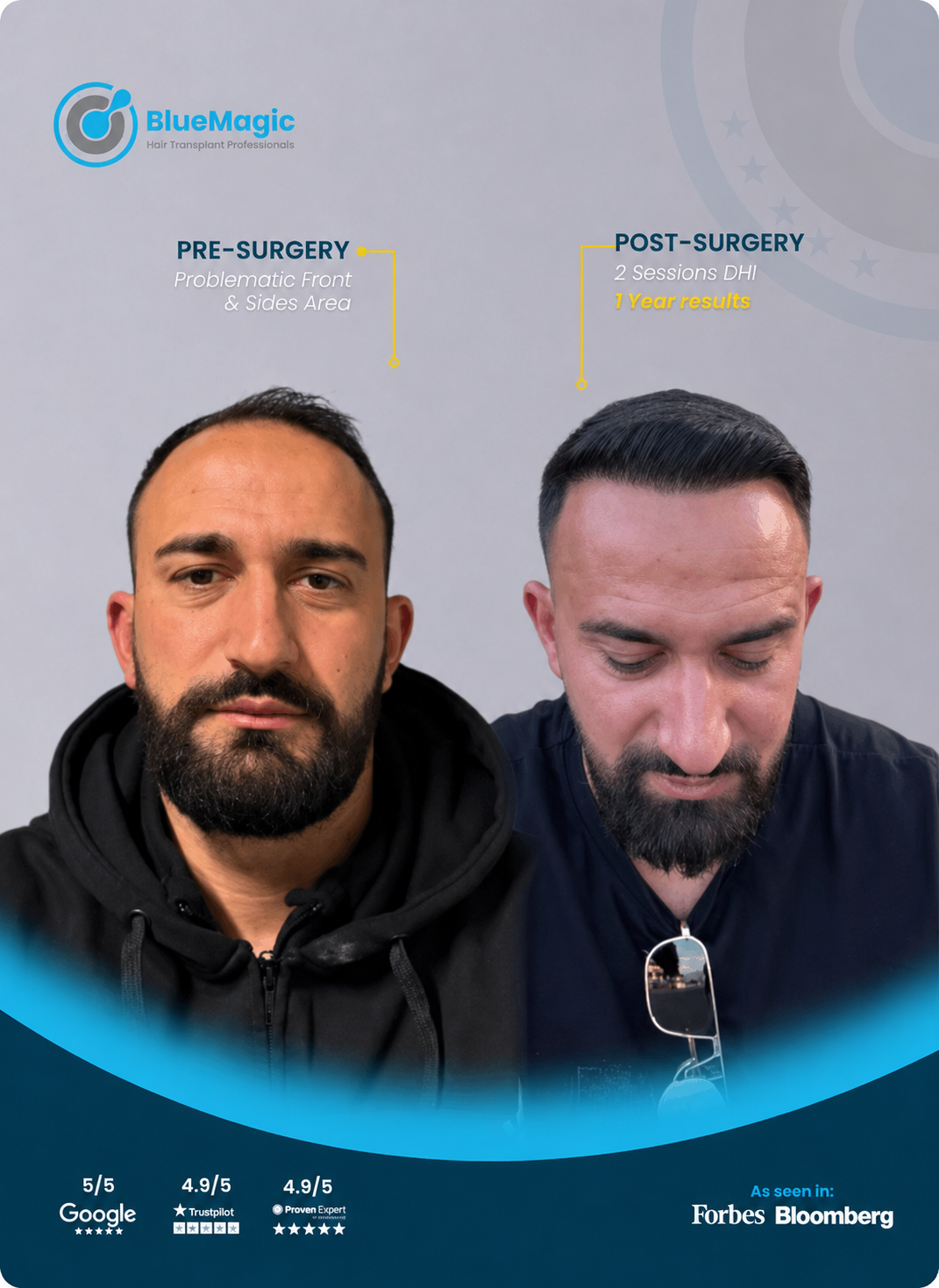 Before and after hair transplant result showing improved frontal density after 1 year.