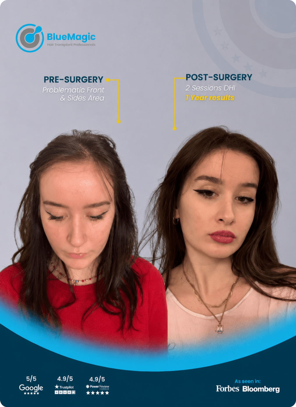 Before and after female hair transplant result showing thicker frontal coverage after 1 year.