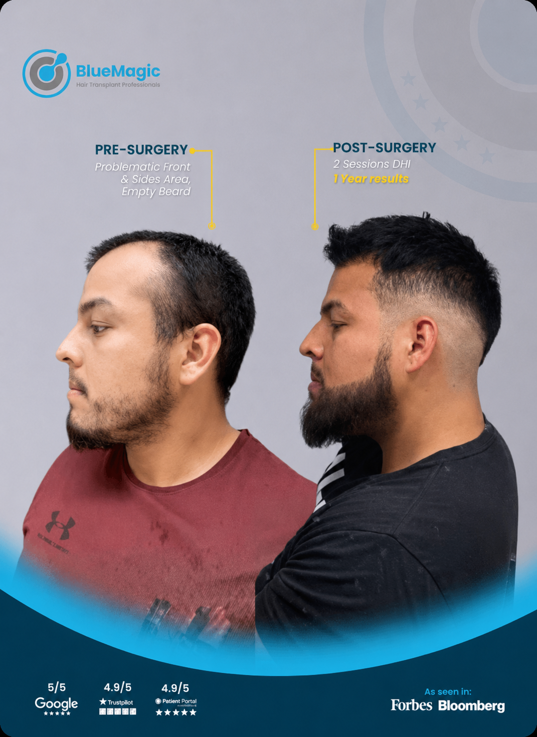 Before and after side-profile hair and beard transplant result after 1 year.